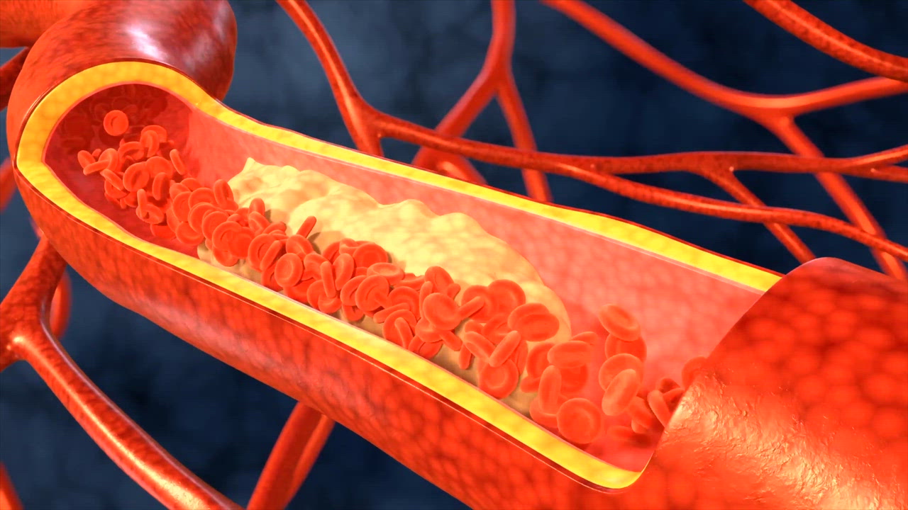 What are the symptoms of heart disease? – video with Dr Ravi Assomull