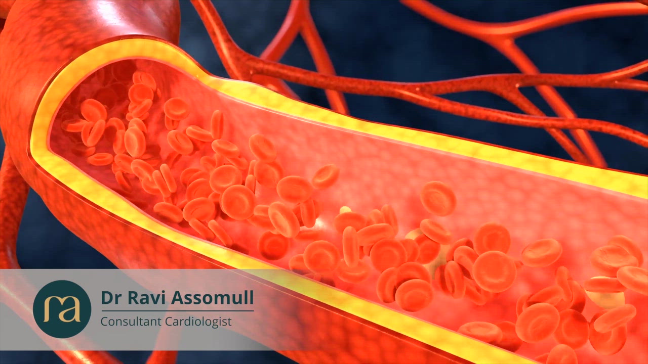 What is coronary heart disease? – video with Dr Ravi Assomull